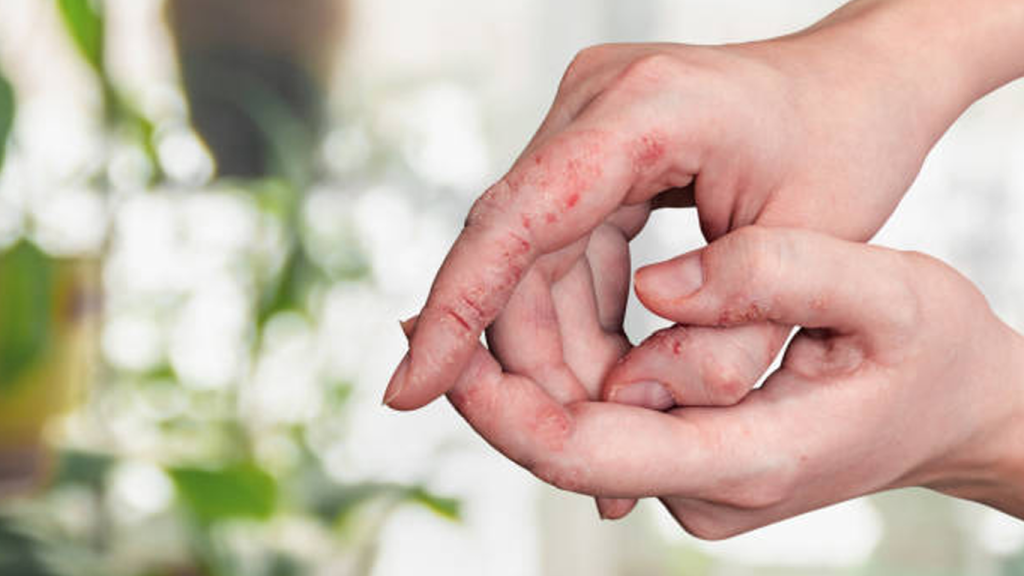 کبد خشک و اگزما