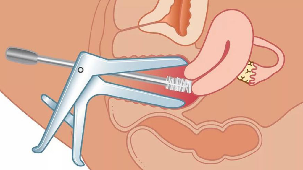 پاپ اسمیر کی انجام میشود