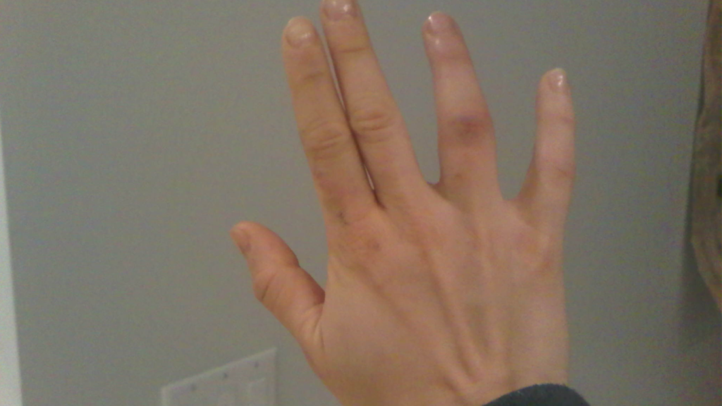 درمان در رفتگی انگشت دست در خانه