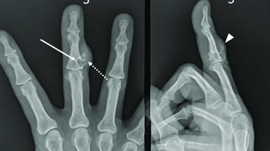 درمان در رفتگی انگشت دست در خانه