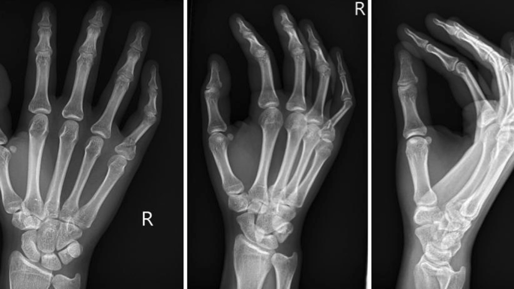 درمان در رفتگی انگشت دست در خانه
