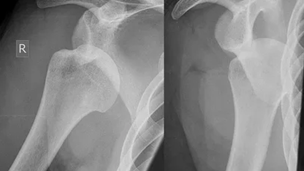 درمان در رفتگی انگشت دست در خانه