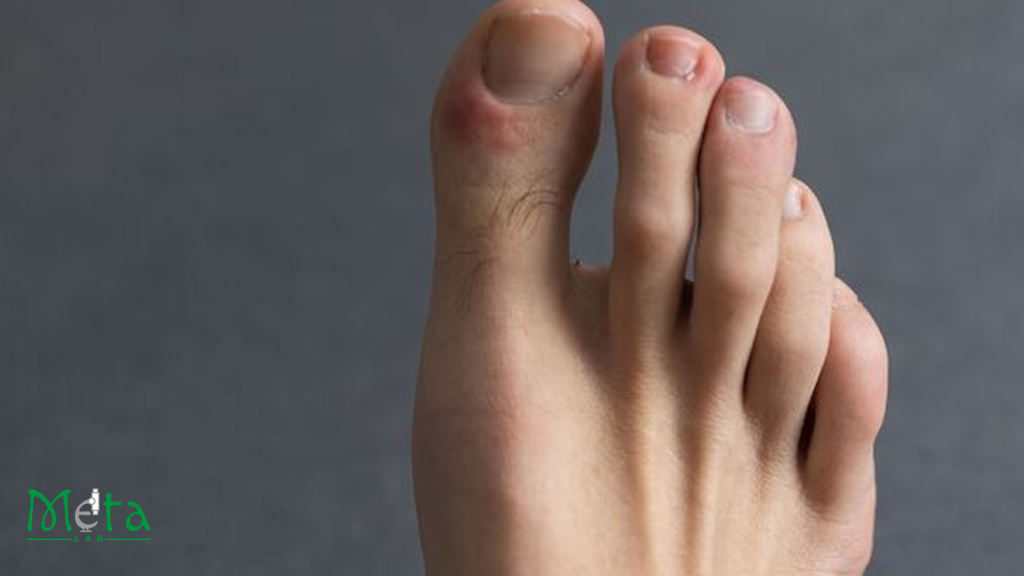 علائم در رفتگی انگشت پا