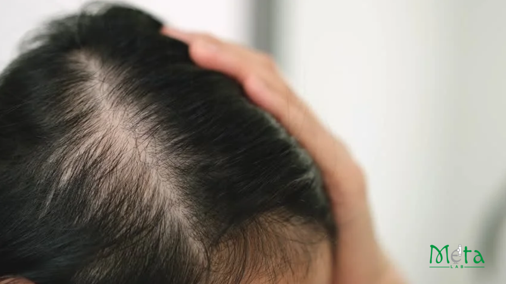 ریزش مو در بانوان