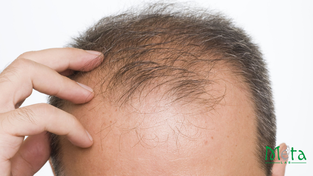 ریزش موی ارثی در بانوان