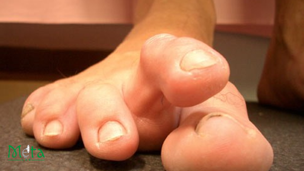 علائم در رفتگی انگشت پا