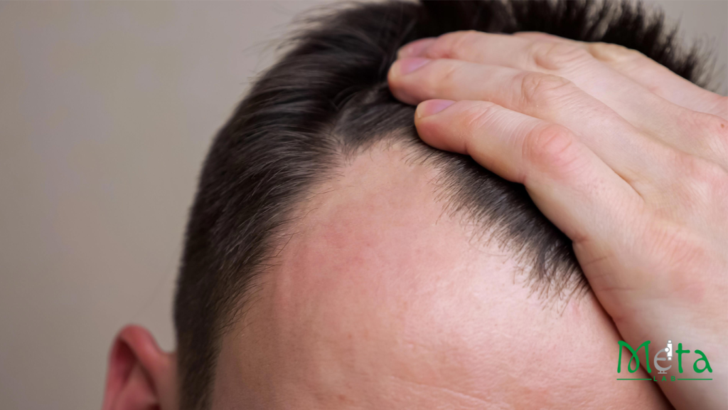 ریزش موی ارثی در بانوان