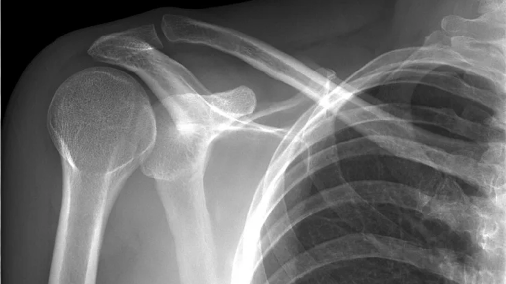 در رفتگی کتف