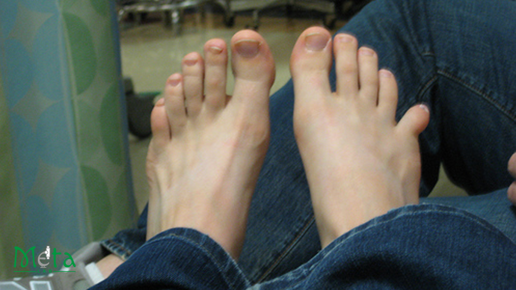 علائم در رفتگی انگشت پا