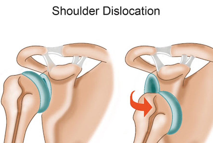در رفتگی کتف