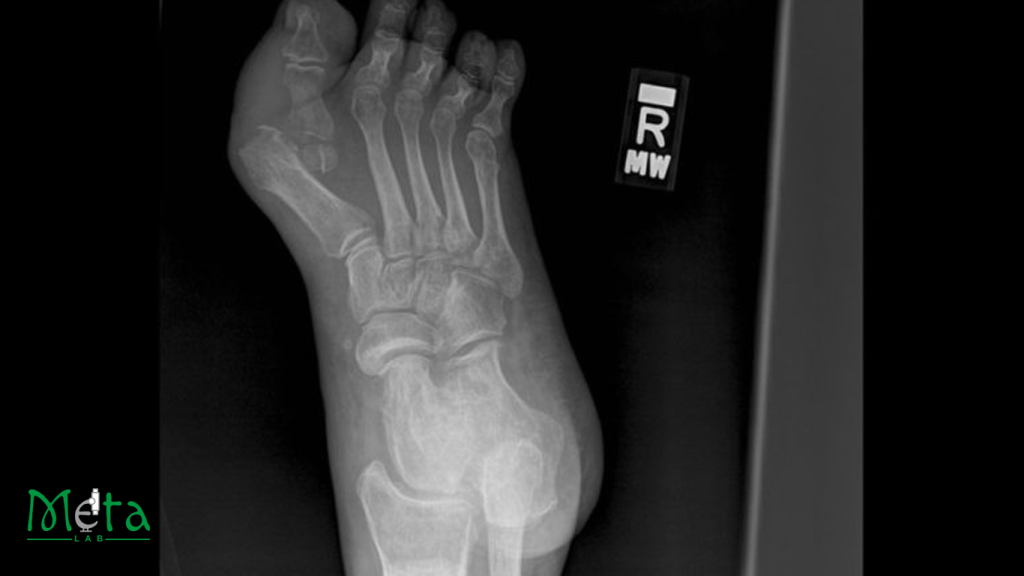 علائم در رفتگی انگشت پا