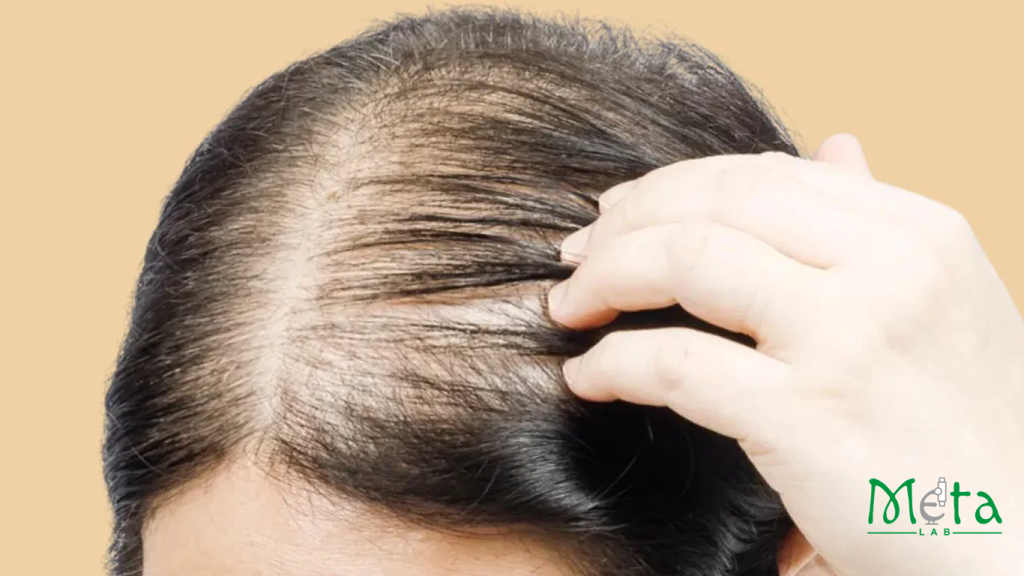 ریزش موی ارثی در بانوان