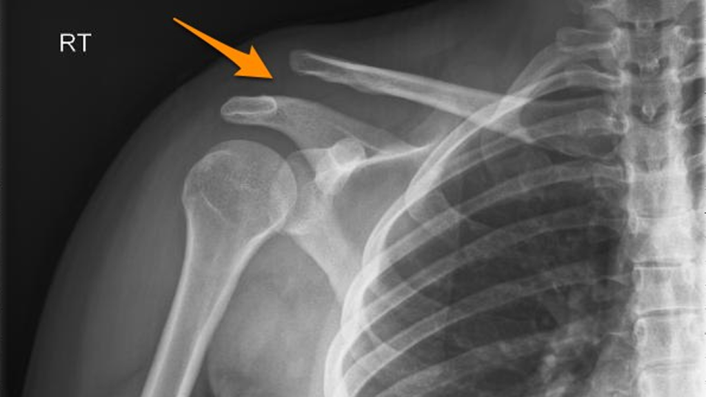 دررفتگی کتف