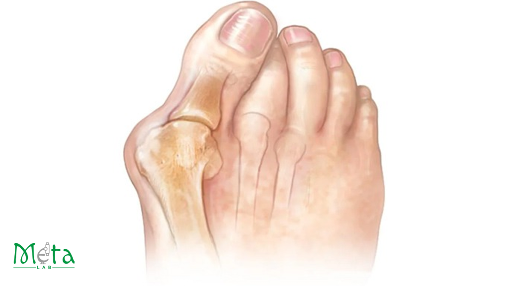 علائم در رفتگی انگشت پا