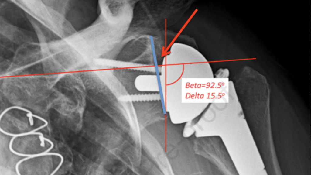 دررفتگی کتف