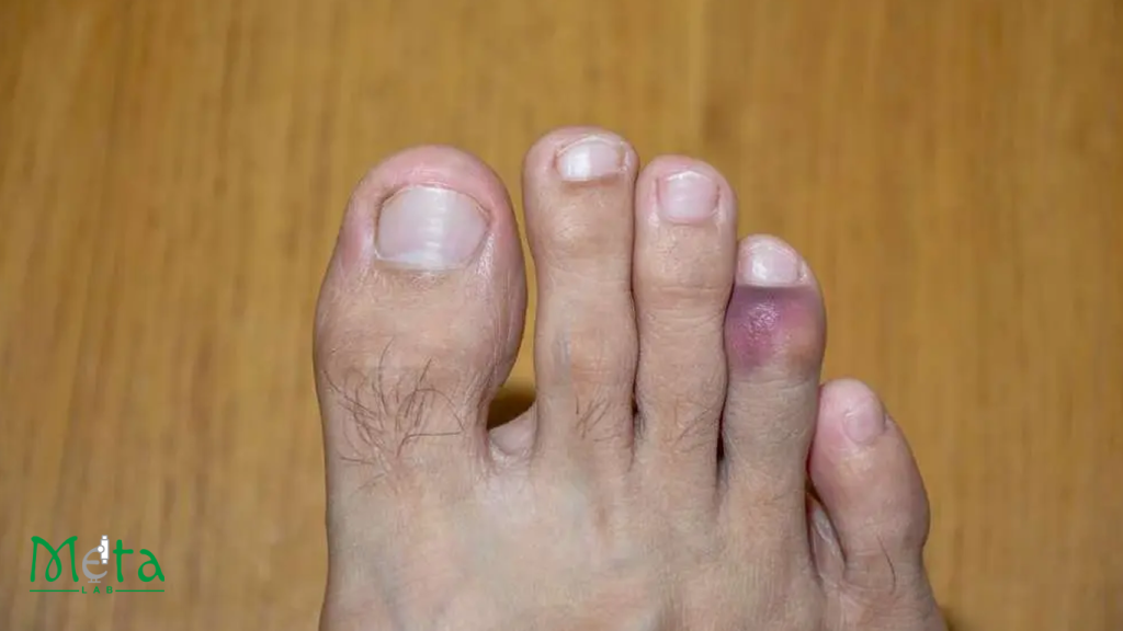 علائم در رفتگی انگست پا