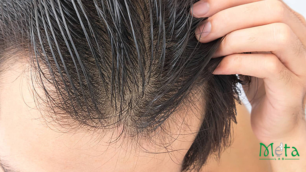 ریزش موی ارثی در بانوان